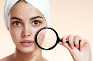 از بین بردن جوش صورت با 5 روش موثر خانگی