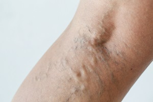 واریس و رژیم غذایی که برای درمان واریس باید رعایت کنید