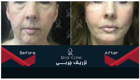عمل زیبایی,تزریق چربی