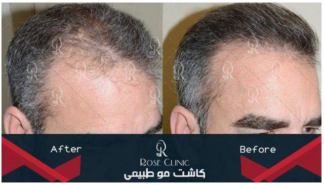 کاشت مو,روشهای کاشت مو,کاشت مو چیست