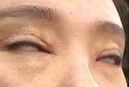 عاقبت جراحی زیبایی پلک عاقبت جراحی زیبایی پلک