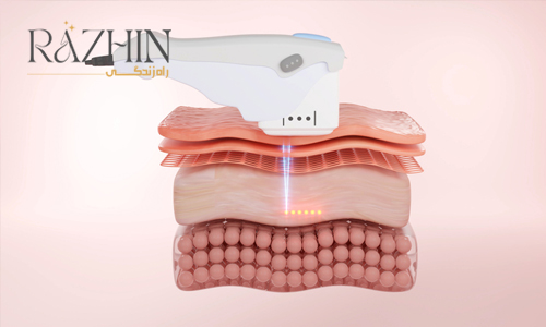 هایفوتراپی hifutherapy.jpg