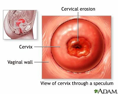 cervical-erosion-1.jpg